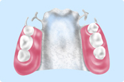 義歯/金属床義歯（チタン）